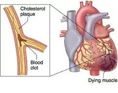 Acute myocardial infarction (Heart Attack)