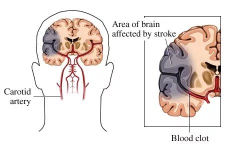 Ischemic Stroke