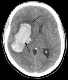 Hemorrhagic Stroke