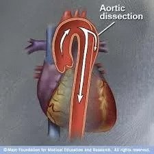 Aortic Dissection