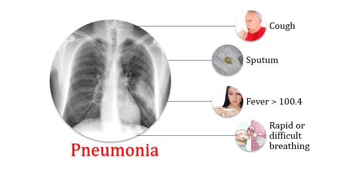 Pneumonia