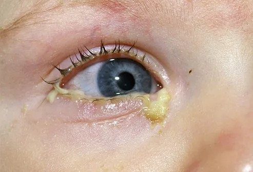 Conjunctivitis