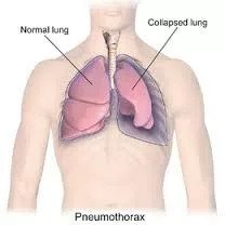 Pneumothorax