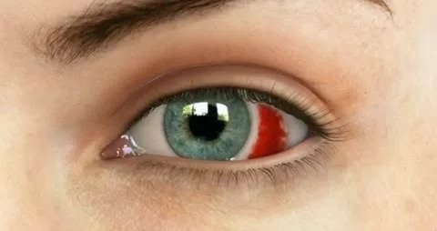 Subconjunctival hemorrhage